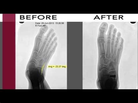 Performing toe raises on a stair can improve arch strength. Next Step Foot and Ankle Clinic's Case of the Month: Flat ...