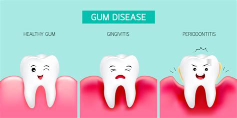 Gum Disease Serenity International Dental Clinic Vietnam