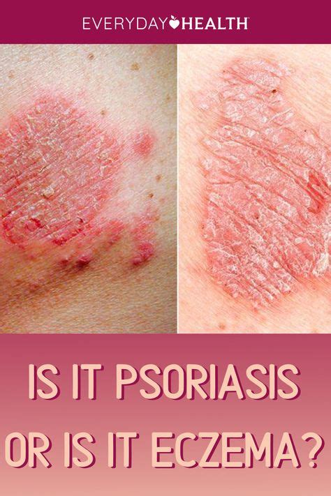 24 Psoriasis Eczema Ideas In 2021 Psoriasis Eczema Eczema Psoriasis