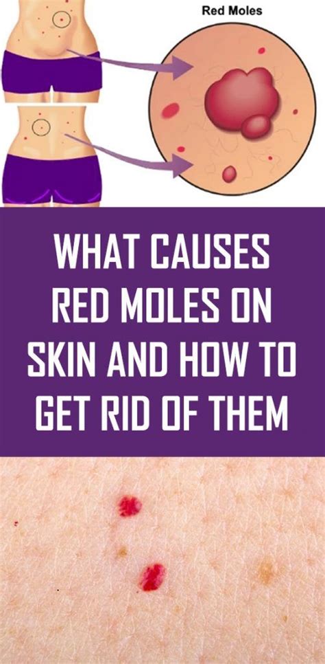 What Causes Red Moles On Skin And How To Get Rid Of Them Healthy Deal 200