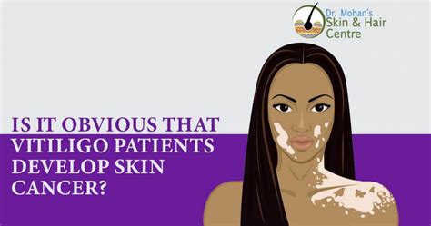 Is It Obvious That Vitiligo Patients Develop Skin Cancer