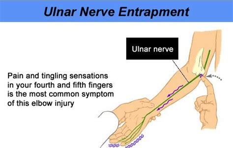 Ulnar Nerve Entrapment What Is It Symptoms Causes Treatment And