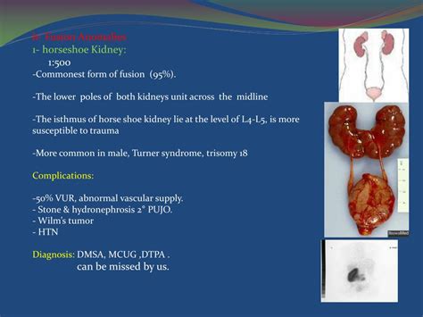 Ppt Congenital Anomalies Of Kidney And Urinary System Powerpoint