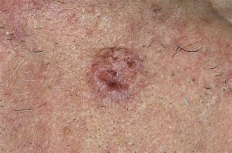 How Serious Is Basal Cell Carcinoma On Face