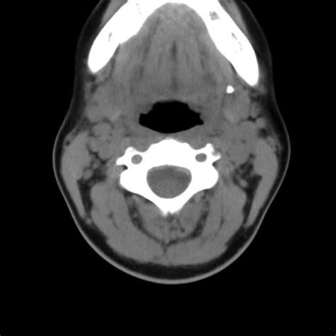 Submandibular Duct Stone Radiology Case Radiology