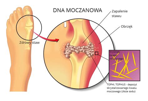 Dna Moczanowa Podagra Artretyzm Leczenie Profilaktyka Naturalnie