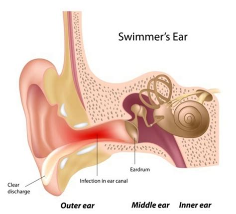 What Is Otitis Externa Swimmers Ear Symptoms Causes And Treatment