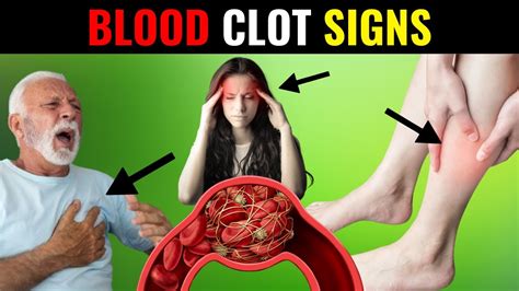 Dont Ignore The Warning Signs Of A Blood Clot Youre At Risk Youtube