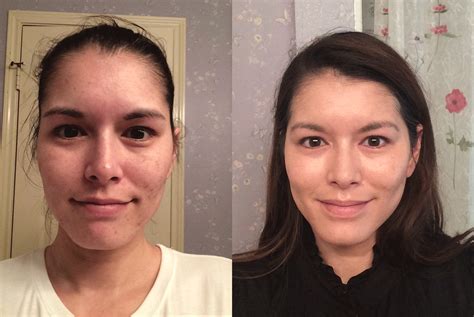 This Girl Has Used Retin A Tretinoin In His Face And The Results Are
