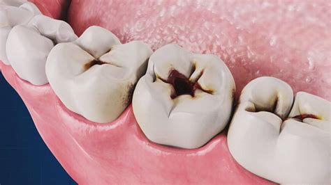 Prévention et traitement de la carie dentaire Le meilleur dentiste d Ispahan le Dr Hossein