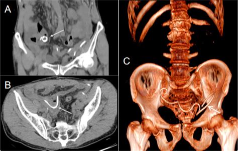 Computed Tomography Ct Scan Of The Abdomen And Pelvis Shows The