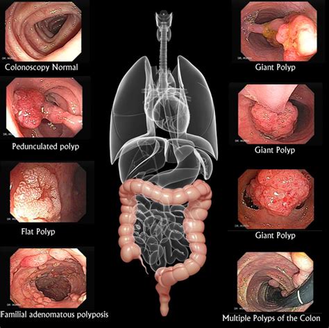 Colorectal Cancer Notes On Cyber Gastroenterology