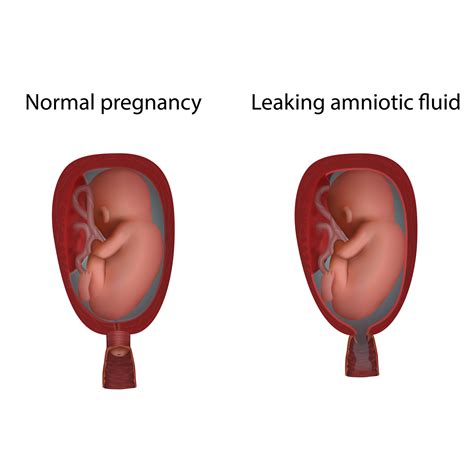 What Does Amniotic Fluid Look Like