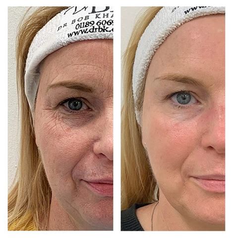 Thread Lifting The Non Surgical Face Lift Drbk Clinic In Reading