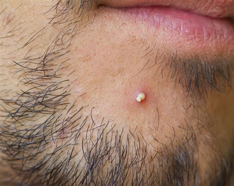 What Are The Common Causes Of Pus In Blisters With Pictures