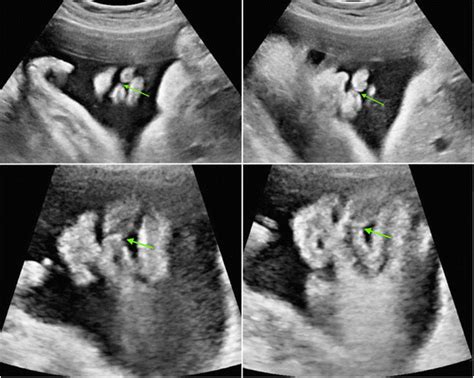 Transabdominal Ultrasonography Of Case 2 35 Weeks Gestation Arrows