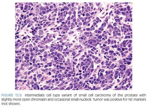 Neuroendocrine Differentiation in the Benign and Malignant ...