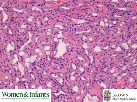 Diagnosis And Management Of An Adenomatoid Uterine Tu Vrogue Co