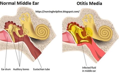 Otitis Media Disease Otitis Media Otitis Symptoms