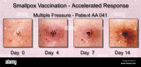 Progression Of The Appearance Of A Smallpox Vaccination Site