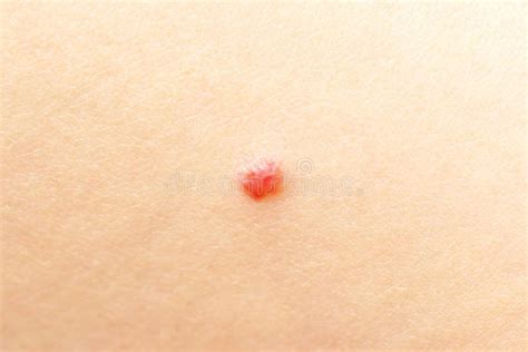 Red Spot On Skin Stock Image Image Of Skin Condition 74992631