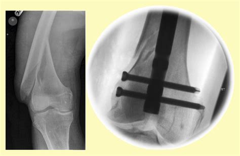 A Distal Diaphyseal Femoral Fracture Treated With Retrograde