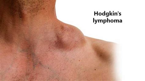 Hodgkin Lymphoma 6 Important Facts To Know Entirely Health