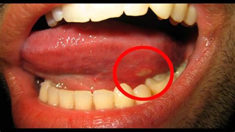 How To Remove Warts Under Tongue Howotre