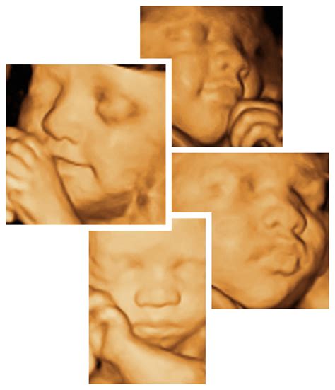 Differences In Imaging Between 2d 3d And 4d Ultrasound 50 Off
