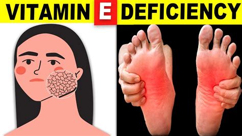 7 Signs Your Body Is Begging For Vitamin E Youtube
