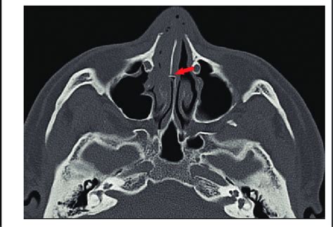 Coexistent Fracture With Involvement Of The Nasal Septum Arrow