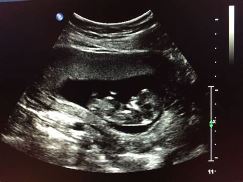 Show Me Your First Baby Ultrasound Pic Page 3