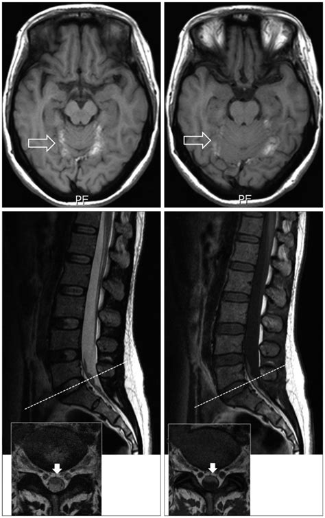 Spinal Subdural Hematoma Following Cranial Subdural Hematoma A Case