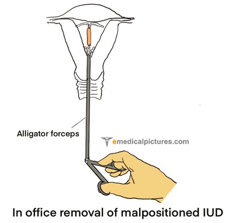 Iud Intrauterine Device Diagram And Images Medical Pictures And Images 2023 Updated