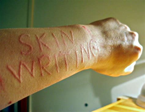 Skin Writing Dermographism Medical Case Rmedizzy