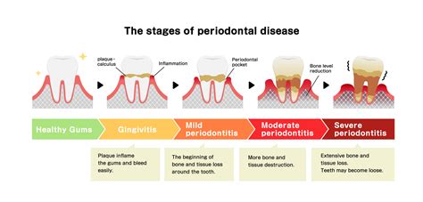 What Damage Can Periodontal Disease Cause Arizona Periodontal Group