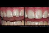 Images of Home Tooth Repair Chipped Tooth