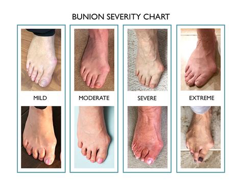 What Is A Bunion