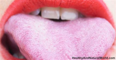 Bumps On Tongue Causes And Natural Treatments