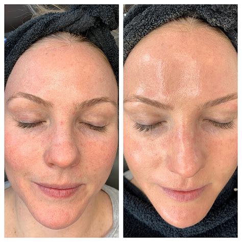 Best Hydrafacial In Denver Hydrafacial Before And After — Mooi