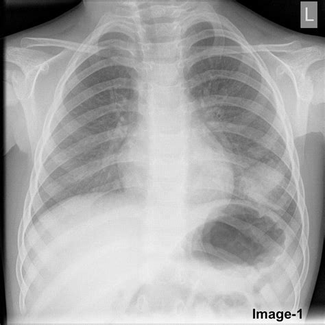 Pneumonia normal chest xray image. Round Pneumonia Ct Scan - ct scan machine
