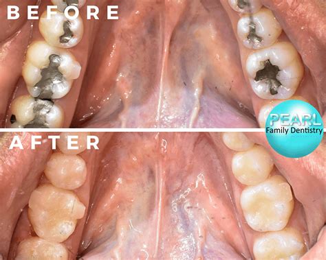 Before And After Amalgam Fillings Replacement Dentist In Merced Ca