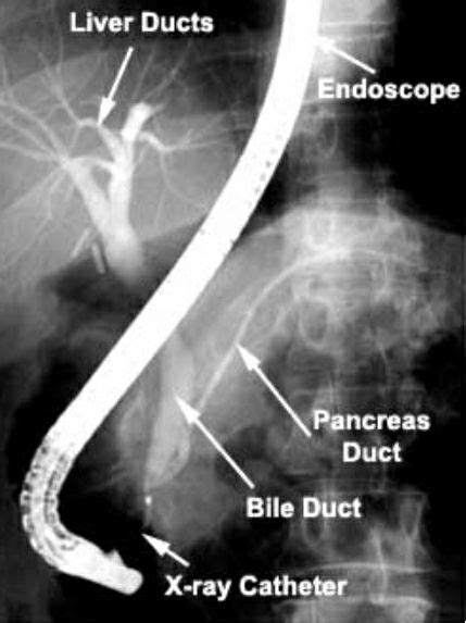 Endoscopic Retrograde Cholengiopancreatography Ercp