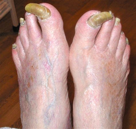 Each type of foot fungus has their own set of symptoms which include Lucie's Foot Care