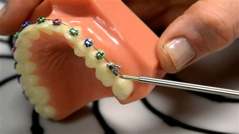 Wax A Great Temporary Fix For Braces With Poking Wire Youtube
