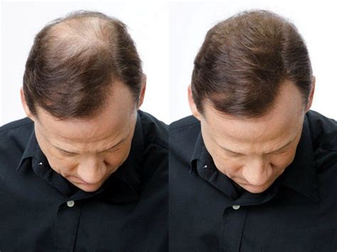 Whilst there are currently no medical providers in japan offering stem cell transplant, you may still be interested in the following, offering similar treatments. Hair Transplant in Islamabad and stem cell therapy ...