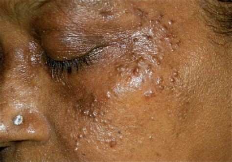 Multiple Translucent Papules On The Face Of A Middle Aged Woman