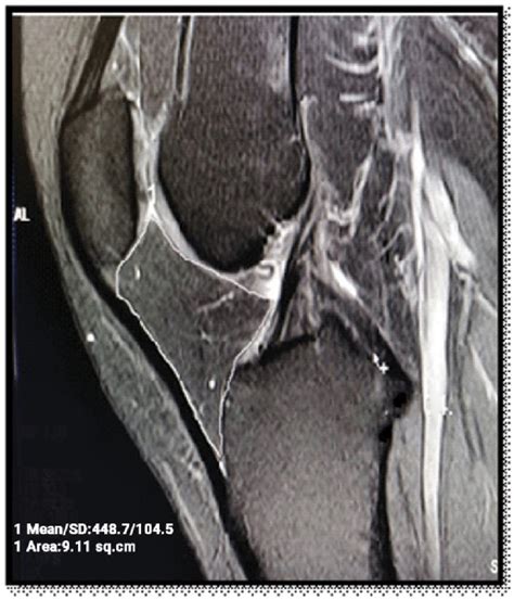 Measurement Of The Infrapatellar Fat Pad Area On Mri A Sagittal T2wi