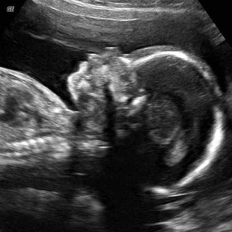 Ultrasound Pictures Week By Week Your Second Trimester