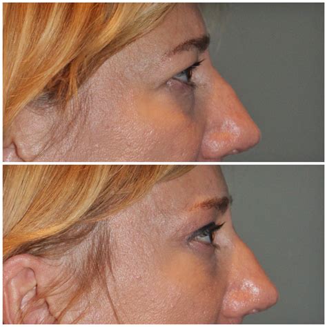 🥇 Atlanta Brow Lift Facial Plastic Surgery Before And Afters Buckhead